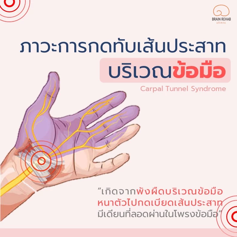 Carpal Tunnel Syndrome (ภาวะการกดทับเส้นประสาทข้อมือ) คืออะไร