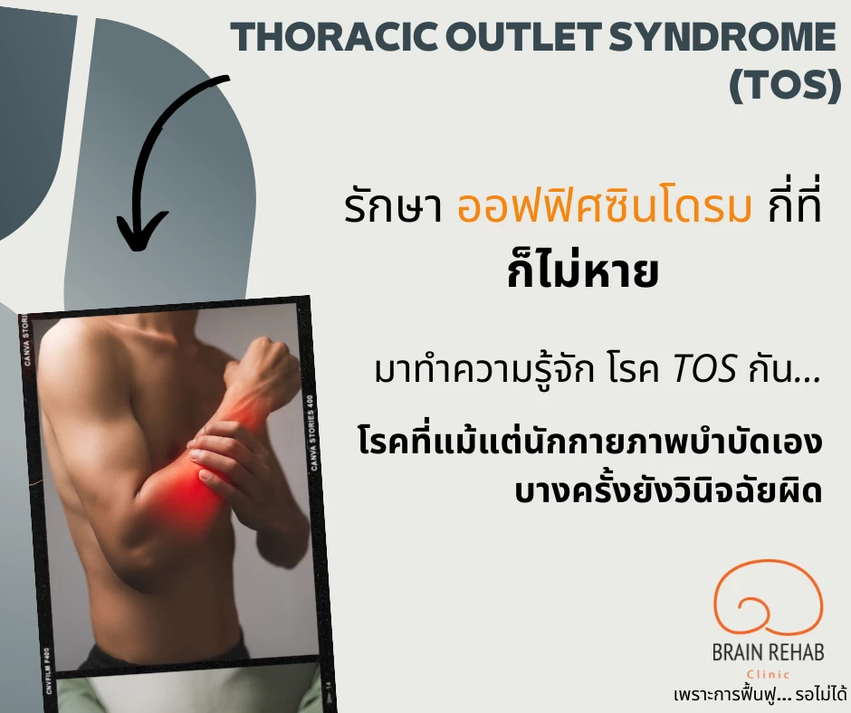 Thoracic Outlet Syndrome (TOS) คืออะไร