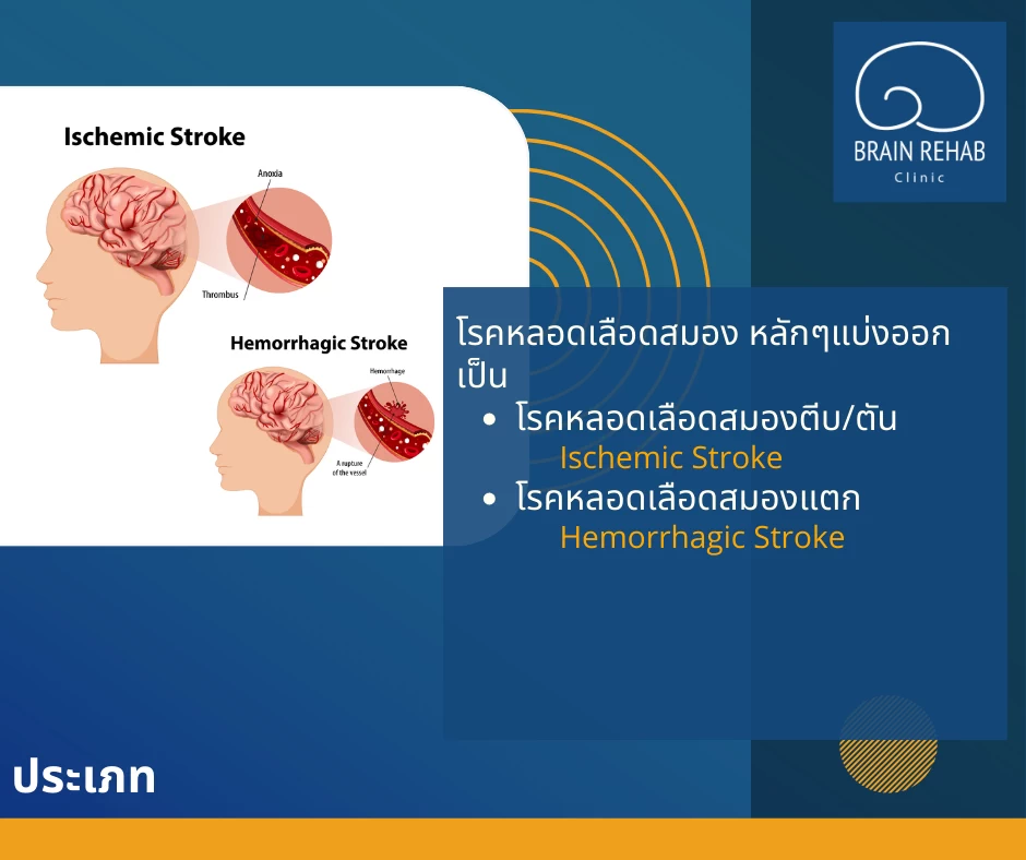 ประเภทของโรคหลอดเลือดสมอง (Stroke) แบ่งออกเป็น