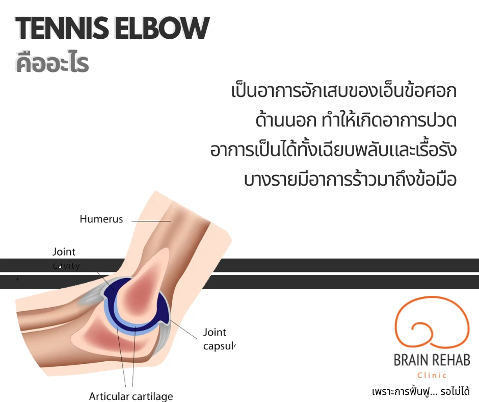 โรคเอ็นข้อศอกอักเสบ (Tennis Elbow) เกิดจากอะไร