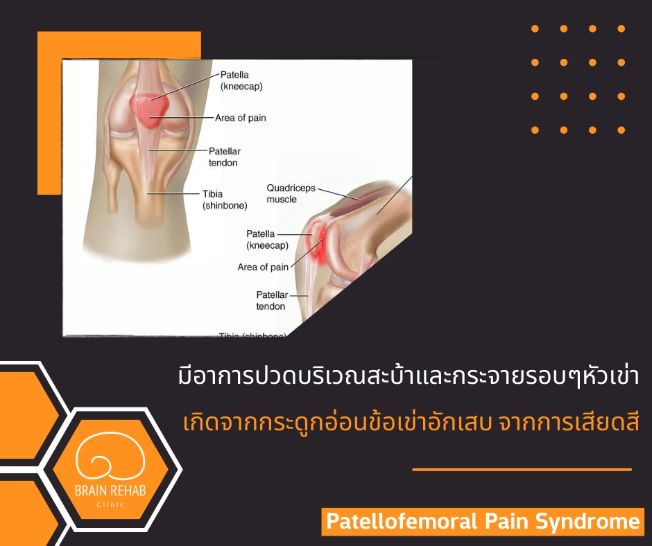 Patellofemoral Pain Syndrome หรือ Runner’s Knee (อาการปวดสะบ้า) คืออะไร
