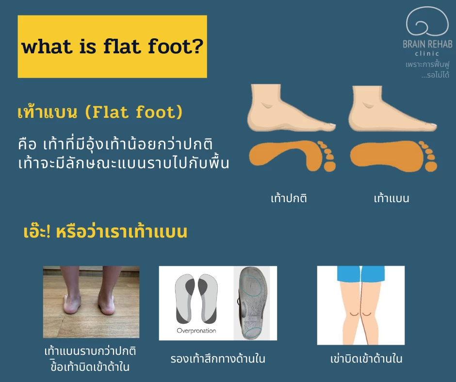 เท้าแบน (Flat Foot) ดูยังไง