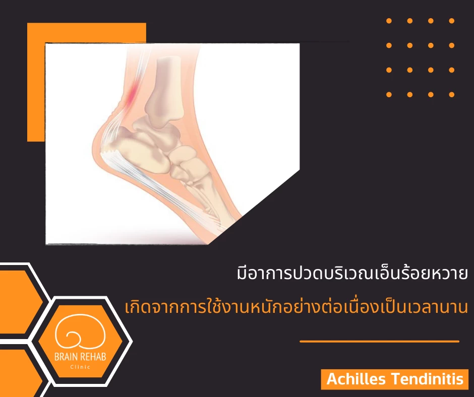 Achilles Tendinitis (อาการเอ็นร้อยหวายอักเสบ) คืออะไร