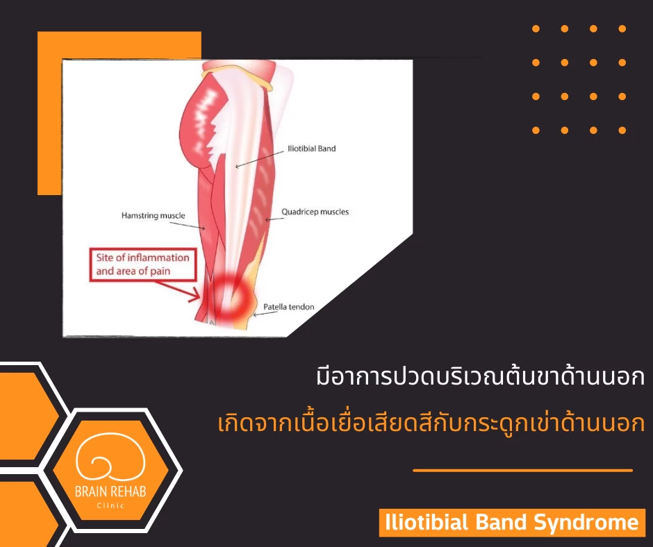 Iliotibial Band Syndrome, ITB (กล้ามเนื้อต้นขาด้านนอกอักเสบ) คืออะไร