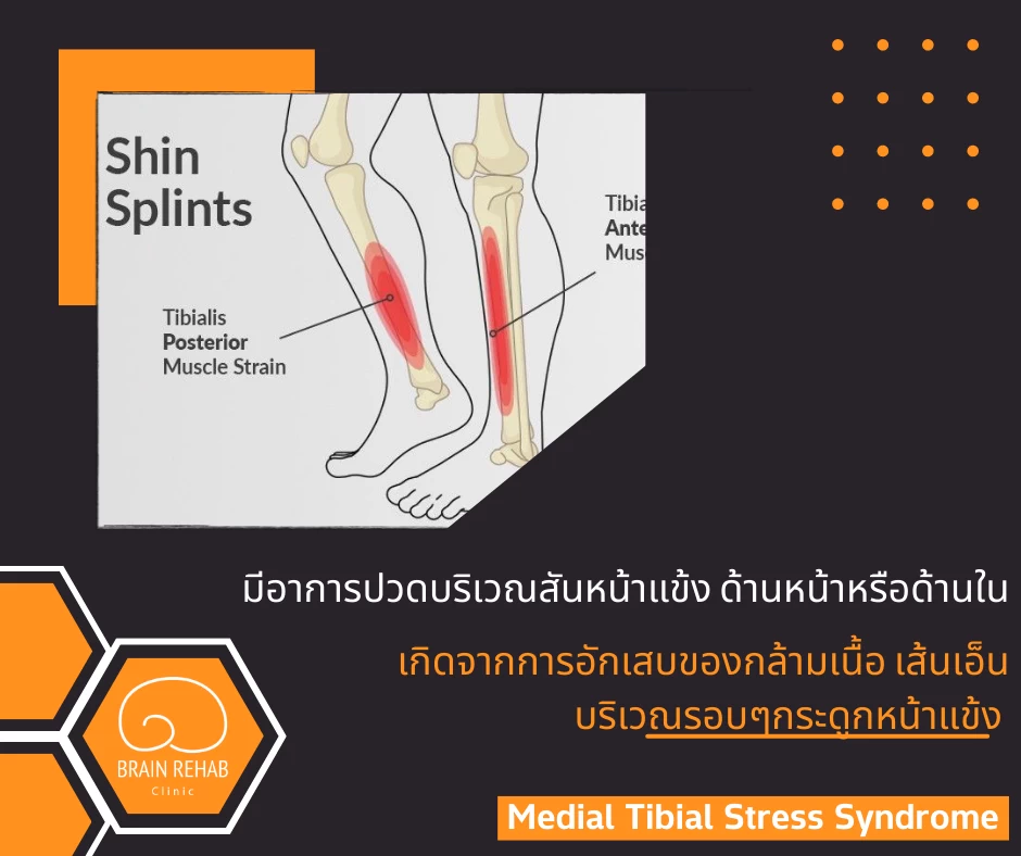 Medial Tibial Stress Syndrome หรือ Shin Splints (กล้ามเนื้อหน้าแข้งอักเสบ) คืออะไร