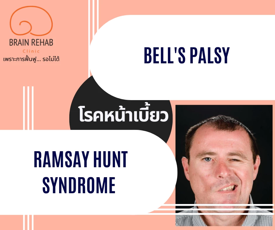 โรคหน้าเบี้ยว (Bell&apos;s Palsy &amp; Ramsay Hunt Syndrome) คืออะไร