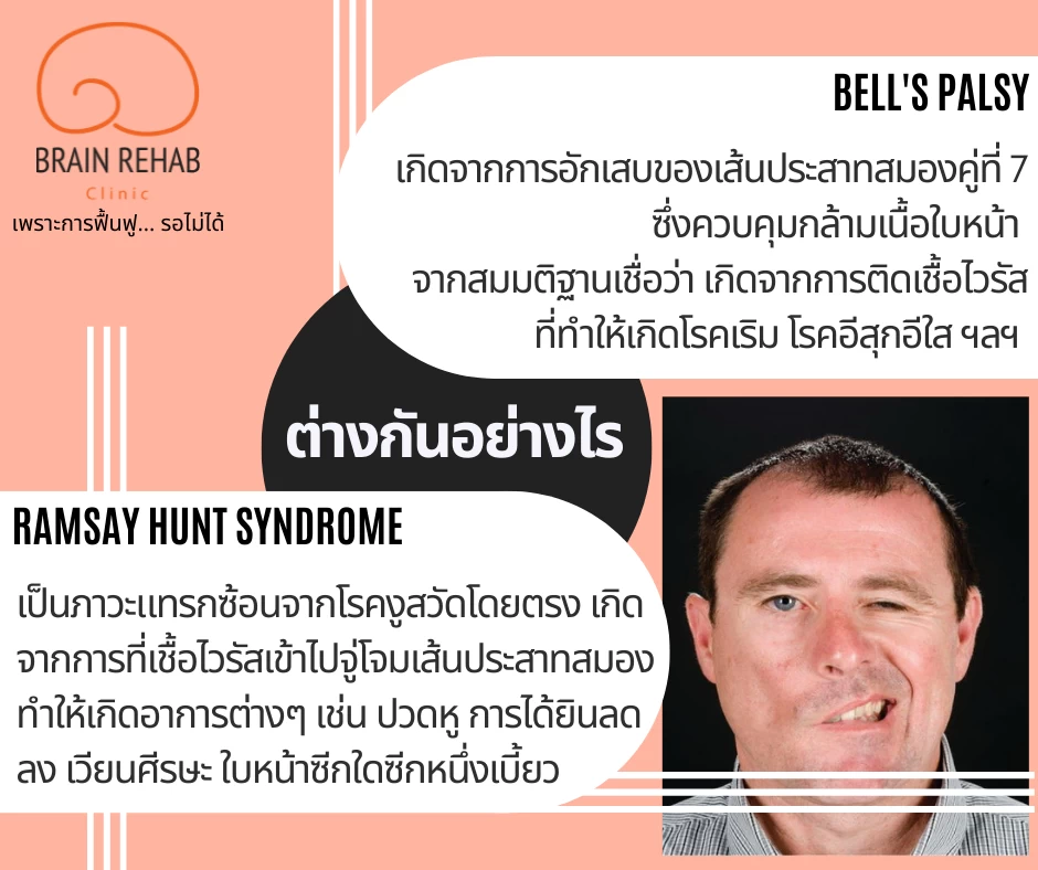 สาเหตุของโรคหน้าเบี้ยว (Bell&apos;s Palsy &amp; Ramsay Hunt Syndrome) เกิดจากอะไร