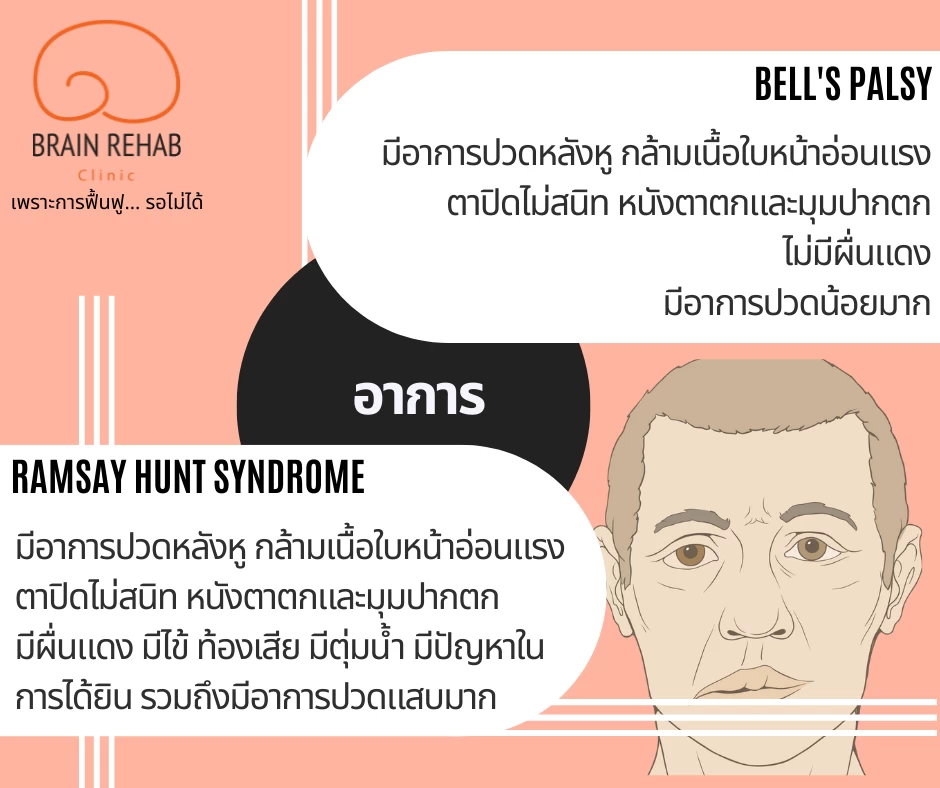 อาการของโรคหน้าเบี้ยว (Bell&apos;s Palsy &amp; Ramsay Hunt Syndrome) เป็นอย่างไร