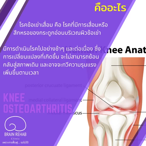 โรคข้อเข่าเสื่อมคืออะไร (Knee Osteoarthritis คือ, OA Knee คือ)