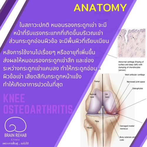 สาเหตุของโรคข้อเข่าเสื่อม (สาเหตุของ Knee Osteoarthritis, สาเหตุของ OA Knee)