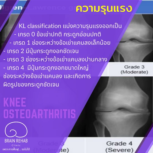 ระดับความรุนแรงของโรคข้อเข่าเสื่อม มีกี่ระดับ (Knee Osteoarthritis ระดับความรุนแรง, OA Knee ระดับความรุนแรง, kl classification)