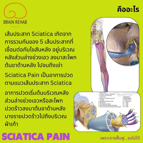 อาการปวดร้าวลงขาคืออะไร เป็นยังไง (Sciatica pain คือ)