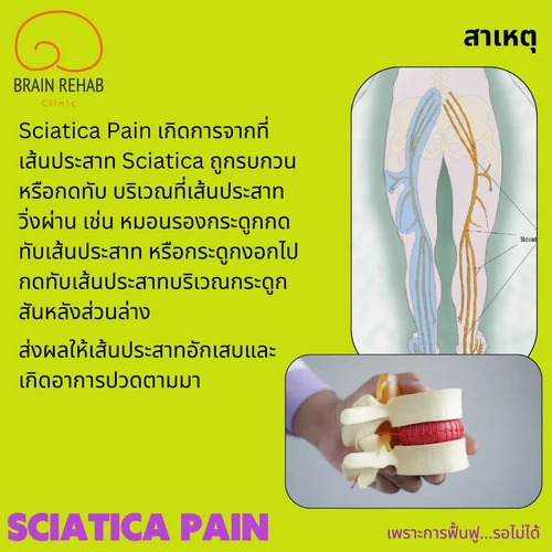 สาเหตุของอาการปวดร้าวลงขา (Sciatica pain สาเหตุ)