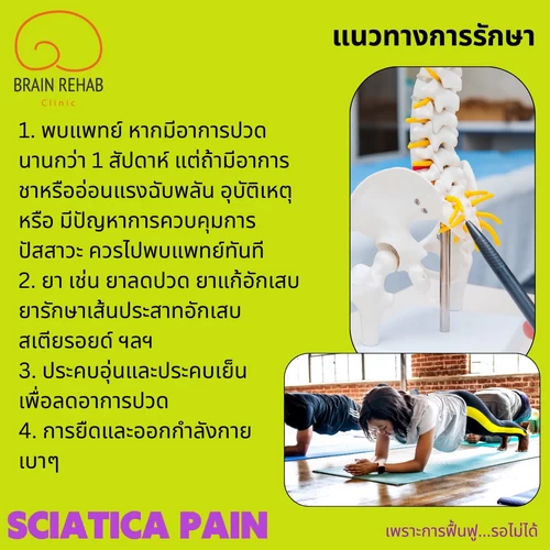 แนวทางการรักษาอาการปวดร้าวลงขา มีอะไรบ้าง (Sciatica pain รักษา)
