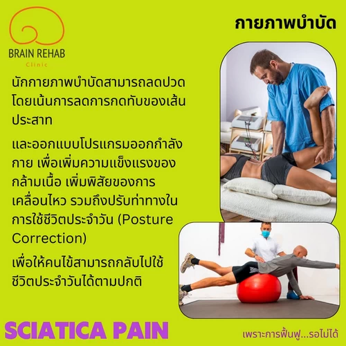 แนวทางการรักษาทางกายภาพบำบัดอาการปวดร้าวลงขา มีอะไรบ้าง กายภาพบำบัดปวดร้าวลงขา ช่วยอะไร (Sciatica pain กายภาพบำบัด)