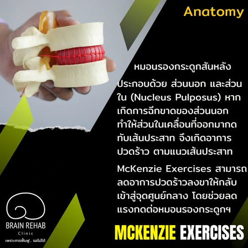 ออกกำลังกายแบบแมคเคนซี่ (McKenzie Exercises) ช่วยลดปวดได้อย่างไร