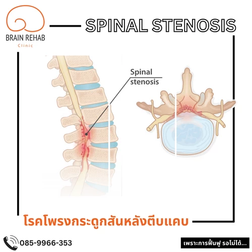 กายภาพบำบัดโรคกระดูกสันหลัง