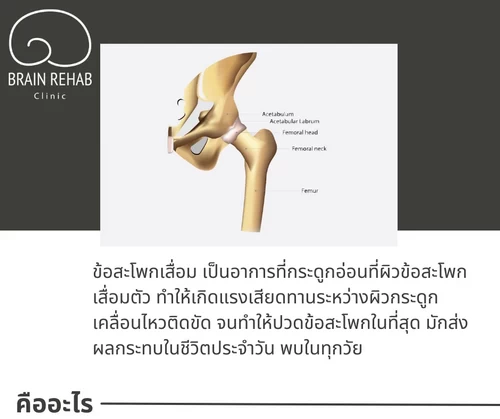 ข้อสะโพกเสื่อม (Hip Osteoarthritis) เกิดจากอะไร