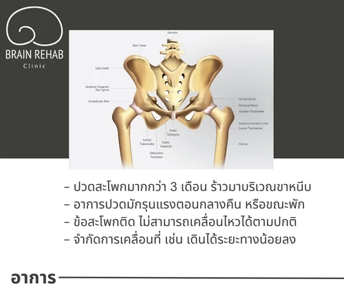 อาการของข้อสะโพกเสื่อม (Hip Osteoarthritis) เป็นอย่างไร