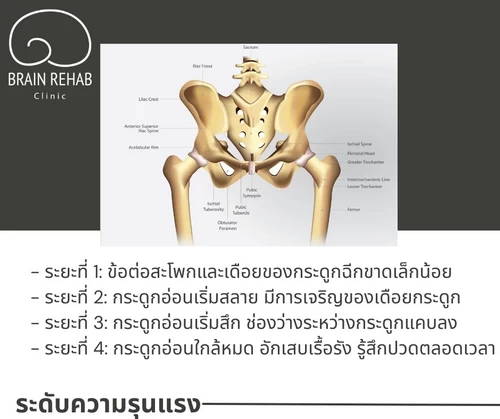 ระดับความรุนแรงของข้อสะโพกเสื่อม (Hip Osteoarthritis) มีอะไรบ้าง