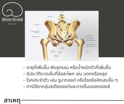 สาเหตุของข้อสะโพกเสื่อม (Hip Osteoarthritis) เกิดจากอะไร