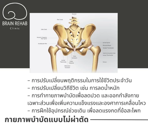 การรักษาข้อสะโพกเสื่อม (Hip Osteoarthritis) ด้วยกายภาพบำบัด แบบไม่ต้องผ่าตัด