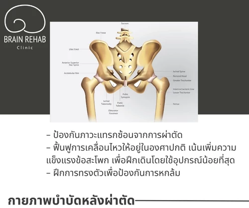 กายภาพบำบัดข้อสะโพกเสื่อม (Hip Osteoarthritis) หลังผ่าตัด ช่วยอะไรบ้าง