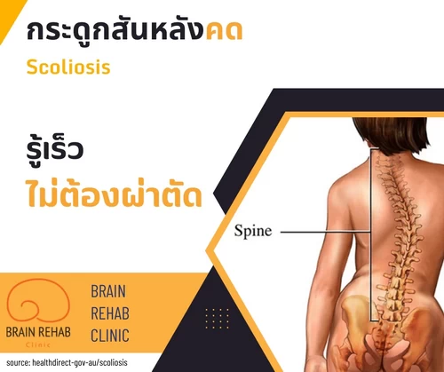 กระดูกสันหลังคด (Scoliosis) คืออะไร