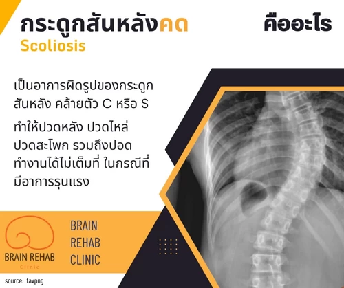 รูปแบบของกระดูกสันหลังคด (Scoliosis) มีอะไรบ้าง