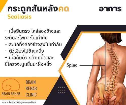 อาการของโรคกระดูกสันหลังคด (Scoliosis) เป็นยังไง