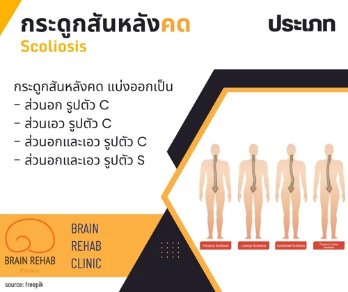 ประเภทของโรคกระดูกสันหลังคด (Scoliosis) แบ่งออกเป็น