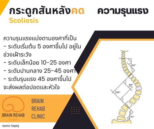 ความรุนแรงของโรคกระดูกสันหลังคด (Scoliosis)