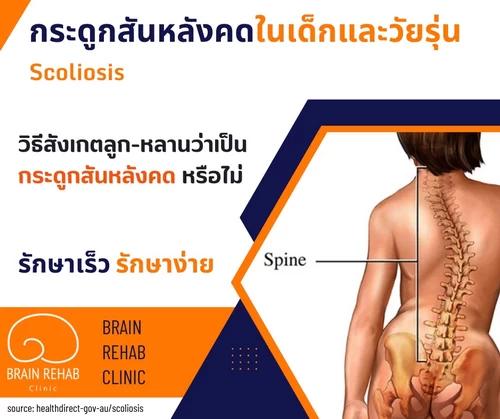 กระดูกสันหลังคด ดูยังไง? (Scolosis Check-up) วิธีสังเกตลูก-หลานว่าเป็นกระดูกสันหลังคดหรือไม่