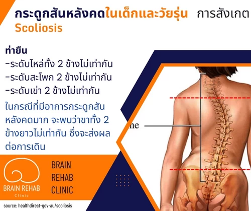 กระดูกสันหลังคด ดูยังไง? (Scolosis Check-up) วิธีการสังเกตุภาวะกระดูกสันหลังในท่าก้มตัว