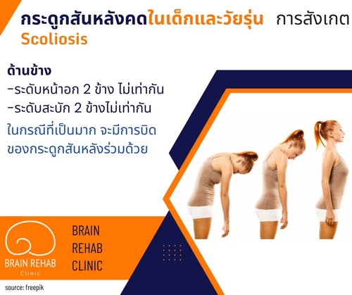 กระดูกสันหลังคด ดูยังไง? (Scolosis Check-up) วิธีการสังเกตุภาวะกระดูกสันหลังคดด้านข้าง