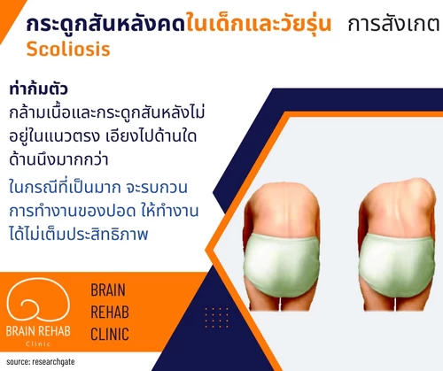 กระดูกสันหลังคด ดูยังไง? (Scolosis Check-up) วิธีการสังเกตุภาวะกระดูกสันหลังในท่าก้มตัว