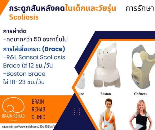 การรักษากระดูกสันหลังคด (Scoliosis) ทางการแพทย์