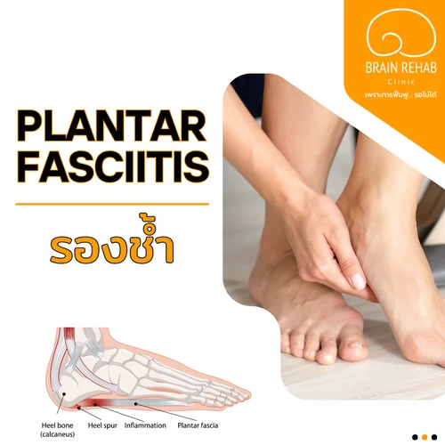 โรครองช้ำ (Plantar Fasciitis)